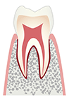 C0：初期虫歯