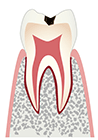 C1：エナメル質が虫歯